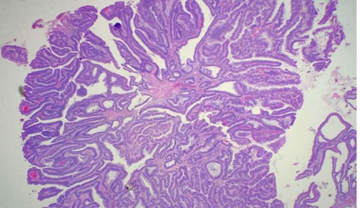 Villous Adenoma