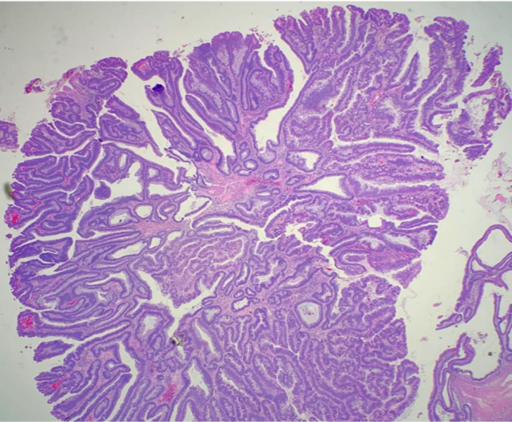 Villous Adenoma