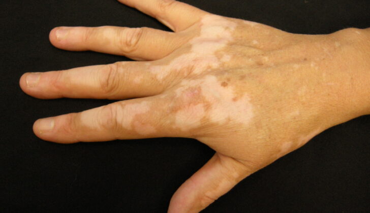 Vitiligo, Hand. Vitiligo is a long-term skin condition characterized by the loss of pigment in certain areas, resulting in white patches on the skin.