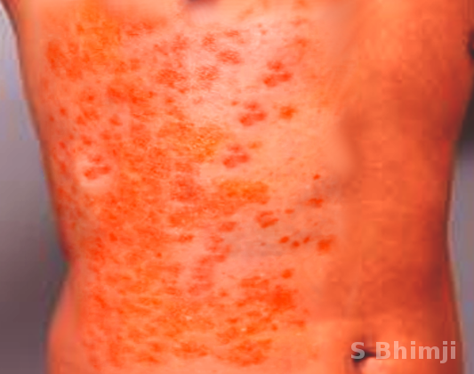 Purpuric rash in WFS