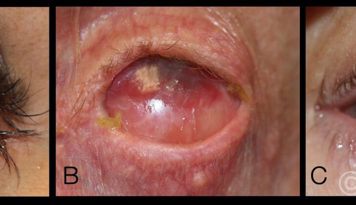 A. Punctal stenosis caused by a chemical burn with conjunctival and lid margin muco-cutaneous junction scarring B. Complete obliteration of the puncta secondary to cicatrization caused by Stevens Johnson syndrome C. Punctal occlusion in the presence of mucous membrane pemphigoid disease