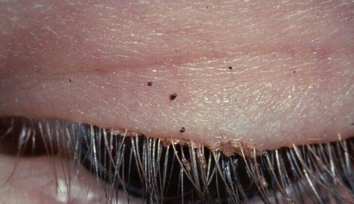 Phthiriasis Palpebrarum. This image shows the eyelashes of a patient infested with Pthirus pubis (pubic or crab lice). Nits, debris, and skin inflammation at the eyelash bases (with jagged edges) are also evident.