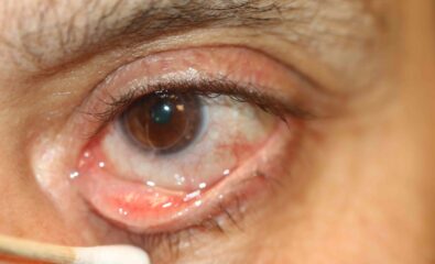 Punctal membrane caused by a chronic follicular conjunctivitis. Membranes may also develop in the presence of nasolacrimal duct obstruction or canaliculitis