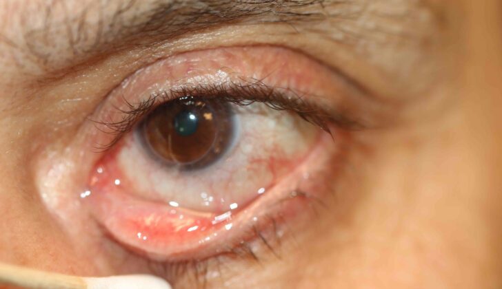 Punctal membrane caused by a chronic follicular conjunctivitis. Membranes may also develop in the presence of nasolacrimal duct obstruction or canaliculitis