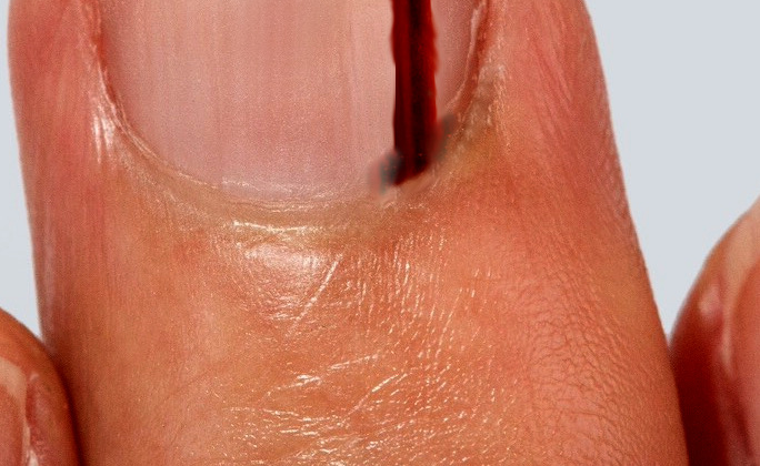 subungual melanoma of the middle finger
