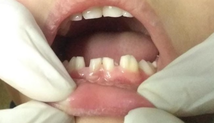 Dental fusion in primary dentition.