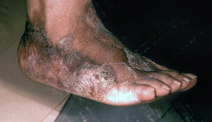 Progressing Eumycetoma With Deep-Tissue Penetration. This image depicts a patient with progressing eumycetoma, showcasing deep-tissue penetration in the right foot.
