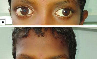 Bilateral Exotropia. (a) Image of the child depicting a 30° exotropia in the left eye while fixating with the right eye in primary gaze. (b) Image of the child showing a 30° exotropia with minimal 5° hypertropia of the right eye while fixating with the left eye in primary gaze suggestive of an alternate exotropia with right eye dissociated vertical deviation