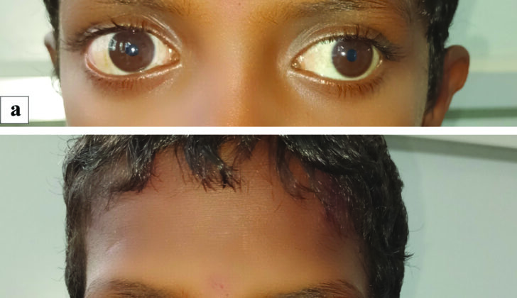 Bilateral Exotropia. (a) Image of the child depicting a 30° exotropia in the left eye while fixating with the right eye in primary gaze. (b) Image of the child showing a 30° exotropia with minimal 5° hypertropia of the right eye while fixating with the left eye in primary gaze suggestive of an alternate exotropia with right eye dissociated vertical deviation