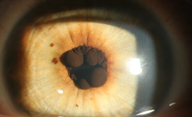 Pigmented Epithelial Cysts on the Iris. The pigmented epithelium on the iris can give rise to primary iris cysts, possibly dislodged into either the anterior or the vitreous chamber.