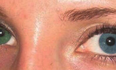 Example of heterochromia.