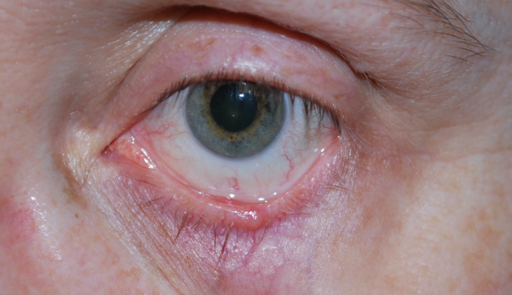 Basal Cell Carcinoma of the left lower eyelid
