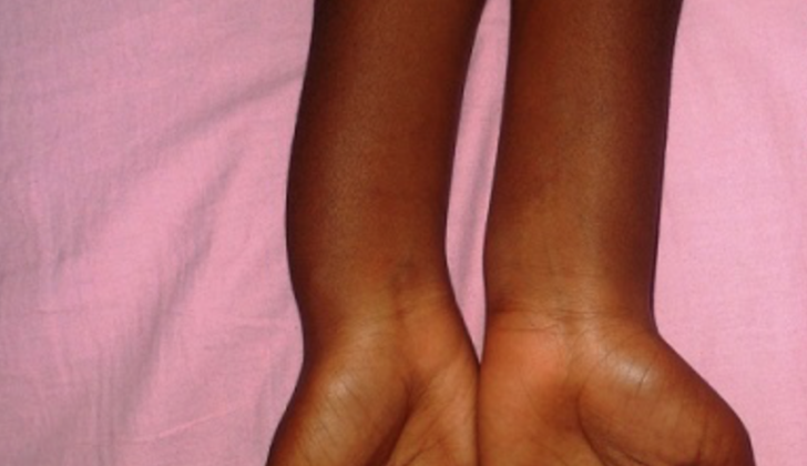Radial Bowing In Madelung Deformity. This clinical image shows right radial bowing in a patient with Madelung deformity. 