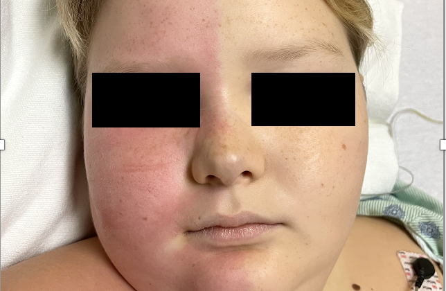 Figure 1: Harlequin syndrome; Unilateral facial flushing sharply demarcated in the midline from the contralateral pallor
