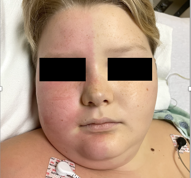Figure 1: Harlequin syndrome; Unilateral facial flushing sharply demarcated in the midline from the contralateral pallor