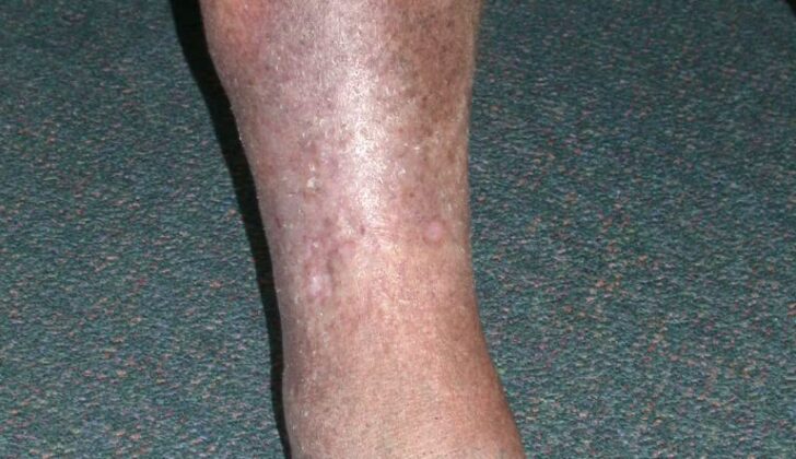 Lipodermatosclerosis