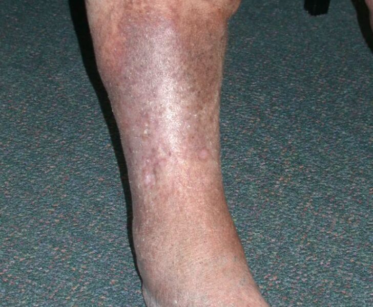 Lipodermatosclerosis