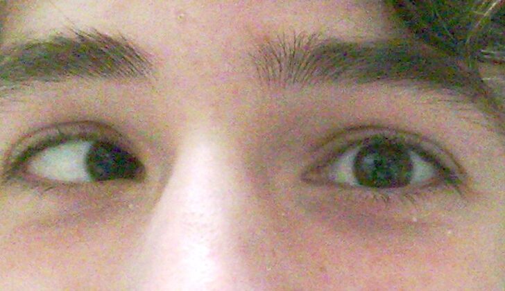 Esotropia of Right Eye