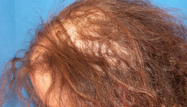 Anagen Effluvium. The image shows the shedding of structurally damaged hairs resulting in diffuse alopecia.