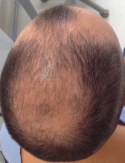 Male-Pattern Androgenetic Alopecia. Hair loss from frontal, temporal, and central scalp areas.