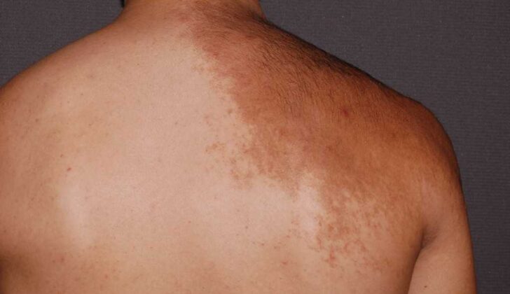 Becker Melanosis. Becker melanosis (Becker nevus) is a form of acquired hyperpigmentation.