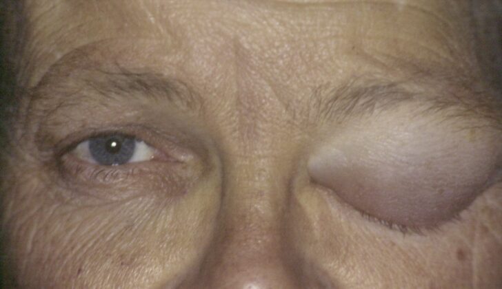 Blepharochalasis: A 48-year-old male presents with his third episode of left-sided swelling which lasts four to five days. Generalized edema of the left upper eyelid tissues with no pain or tenderness