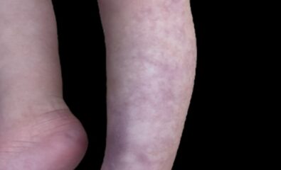 cutis marmorata telangiectatica congenita