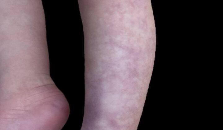 cutis marmorata telangiectatica congenita