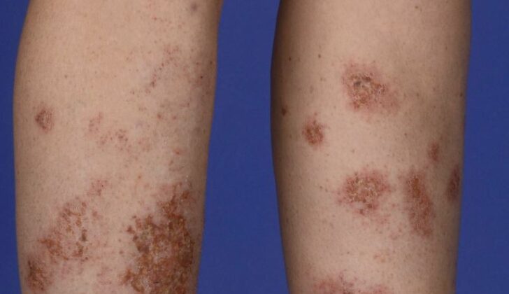 Nummular Dermatitis