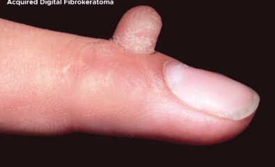 Acquired Digital Fibrokeratoma on index finger.