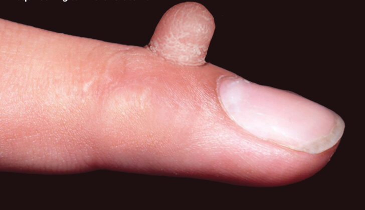 Acquired Digital Fibrokeratoma on index finger.