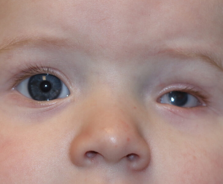 Enophthalmos, Microphthalmos. Microphthalmos may result in a smaller globe and smaller diameter of the cornea and may be mistaken for enophthalmos.