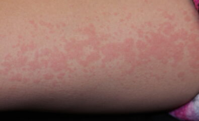 Systemic Onset Juvenile Idiopathic Arthritis. Juvenile idiopathic arthritis is usually accompanied by a salmon-colored maculopapular rash.