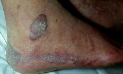 Kaposi Sarcoma