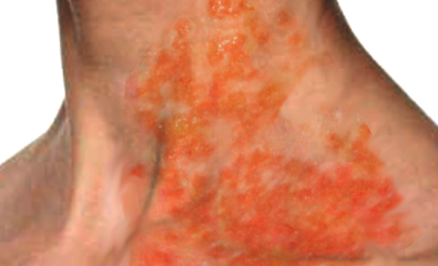 Kaposi Varicelliform Eruption. Kaposi varicelliform eruption, also called eczema herpeticum, refers to a disseminated skin infection due to a virus that usually leads to localized vesicular eruptions that occur in a patient with an underlying cutaneous disease. Although rare, it is a potentially life-threatening disorder. Herpes simplex virus is considered the primary causative agent.