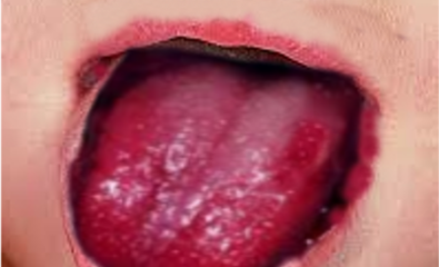 Strawberry tongue KD