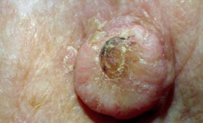 Keratoacanthoma