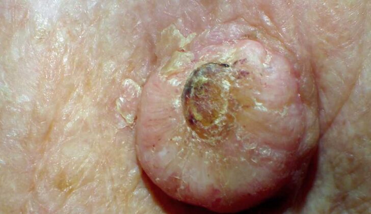 Keratoacanthoma