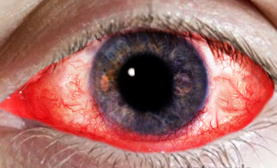 Keratoconjunctivitis