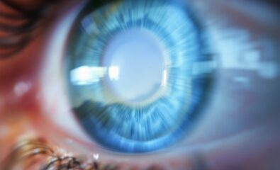 Keratoconus