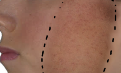 Keratosis pilaris