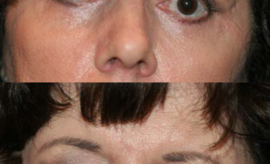 Lagophthalmos: patient with over-aggressive upper and lower blepharoplasty with shortage of skin and over-aggressive removal of orbicularis muscle. The lagophthalmos seen is worse when the patient is asleep than what is seen when the patient is awake and closing the eyelids.