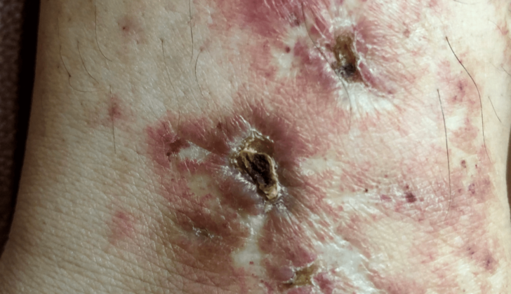 Livedoid vasculitis