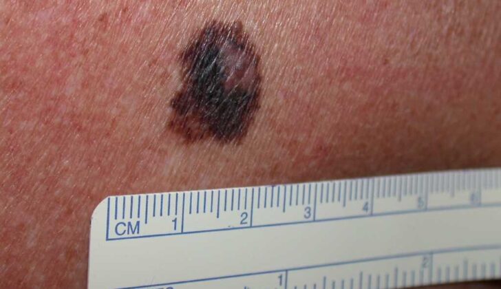 Melanoma  