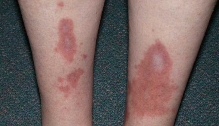 Necrobiosis Lipoidica, Lower Extremities