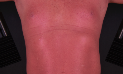 Pityriasis Rubra Pilaris With Erythroderma. Characteristic bright red plaques with a few islands of sparing on the lower abdomen of a patient with PRP.