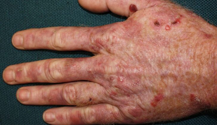Porphyria Cutanea Tarda