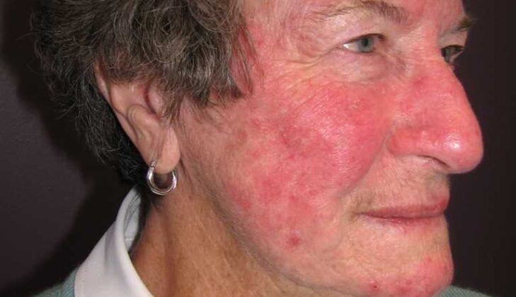 Rosacea, Face