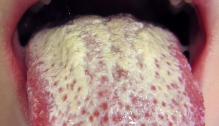 Acute pseudomembranous candidiasis of the dorsum of the tongue.