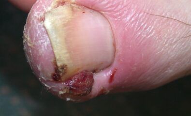 Ingrown Toenail. An ingrown toenail occurs when the nail plate grows into the periungual skin and causes inflammation and infection. It can cause considerable pain, discomfort, and disability if left untreated.